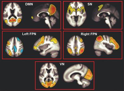 White-Matter Hyperintensity Load and Differences in Resting-State Network Connectivity Based on Mild Cognitive Impairment Subtype